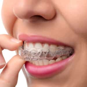 How Does Invisalign Work?