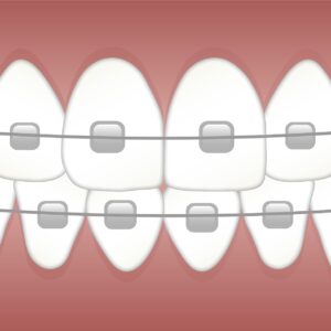 Adult Braces: Everything You Need to Know